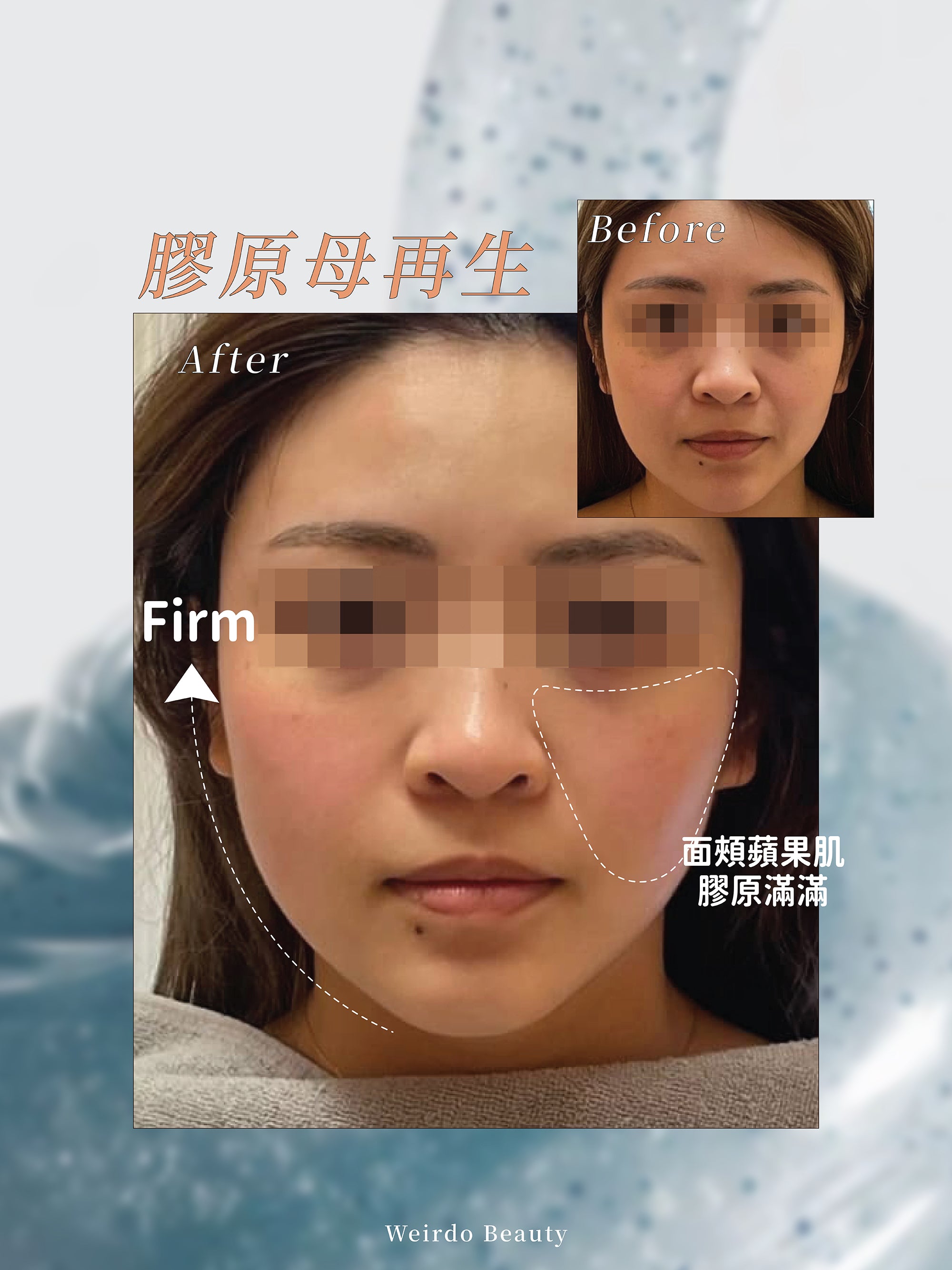 【去法令紋·蘋果肌提升】VIVA RF 膠原母再生